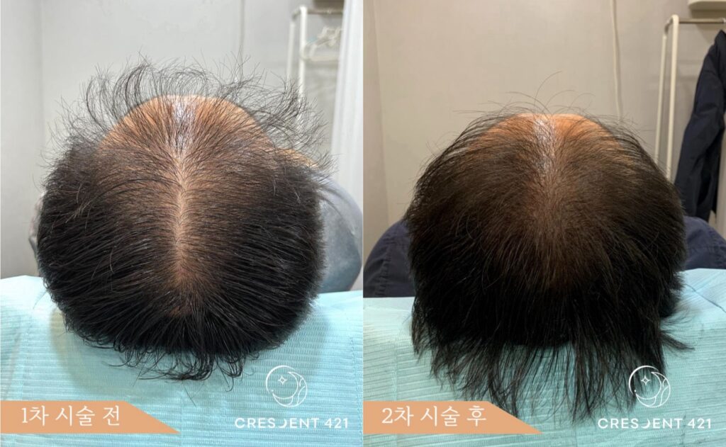 남성 정수리 smp ( 시술 전 / 2차 후 )